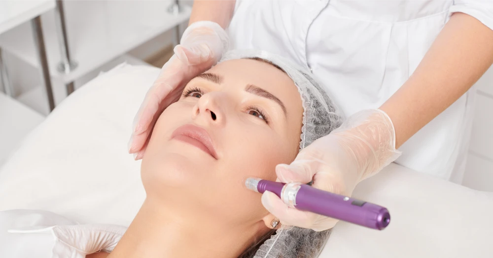 How Long Does Microneedling Last?