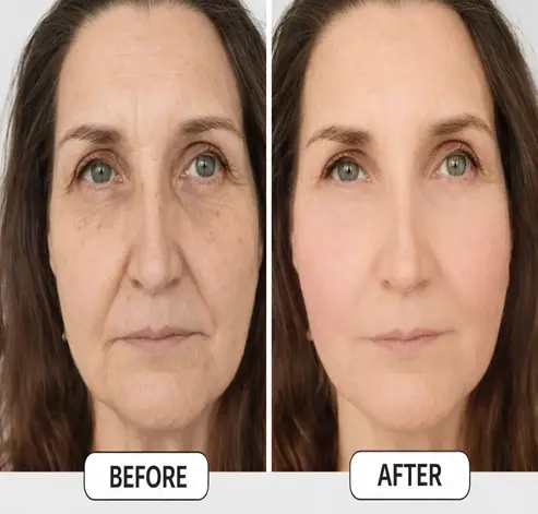 AFTER THE BOTOX TREATMENT