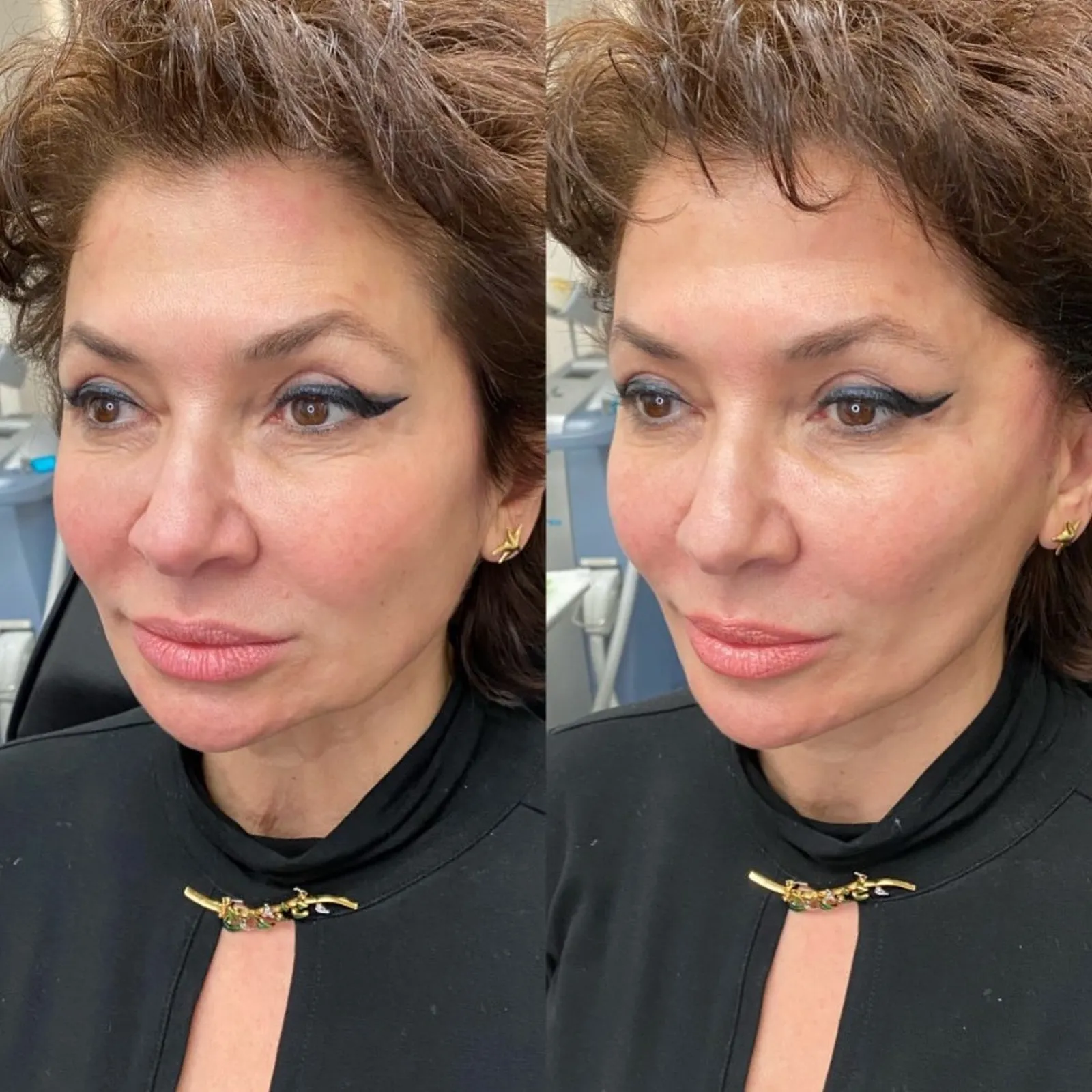 Before Getting Mesotherapy: Understand the Risks, Benefits, and How to Pick the Best Clinic